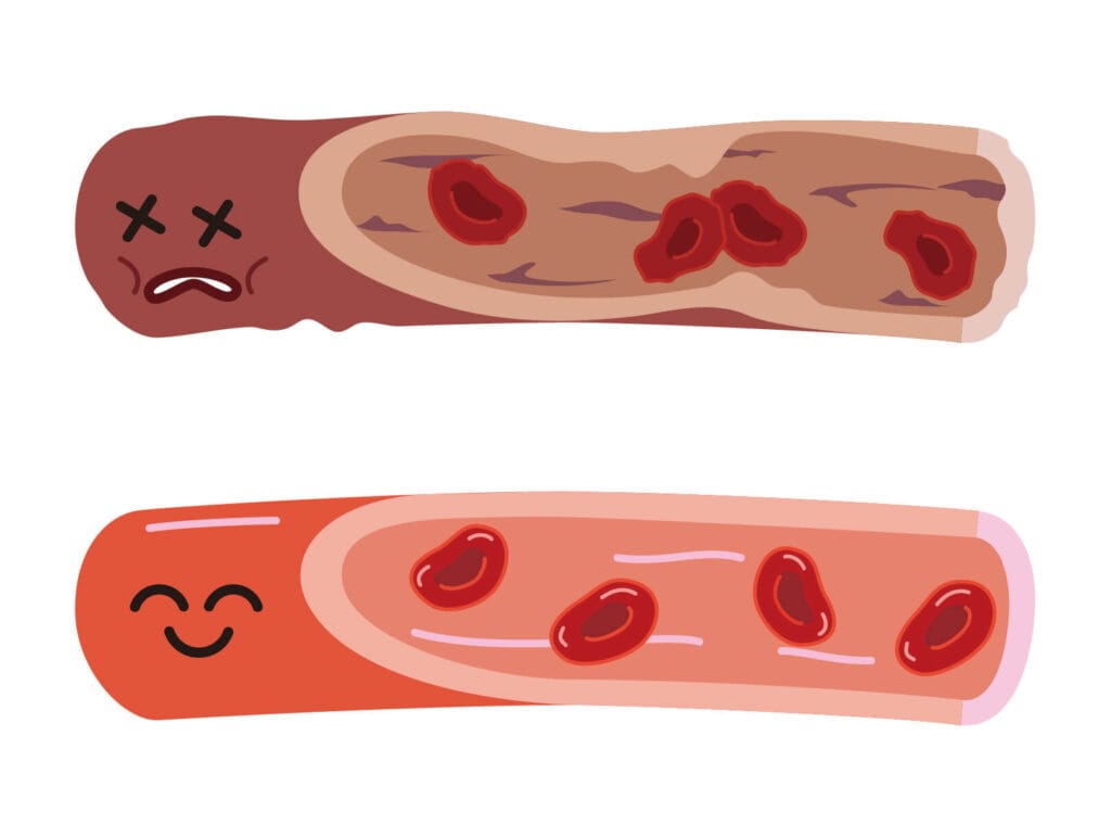 循環好不好和動脈硬化怎麼測試~4肢綁血壓帶就可以輕鬆測量 2 目前較便利使用的動脈硬化檢測儀,稱為肱踝脈波傳導速率(brachial-ankle PWV, baPWV)檢測