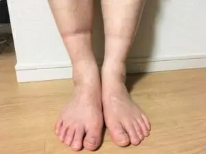 兩隻腳都腫和只有一隻腳腫的原因其實差蠻多的，因此要先分清楚是只有一腳還是兩隻腳，再來判斷是什麼原因導致。