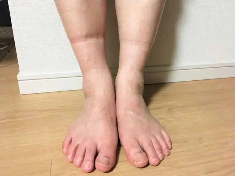 兩隻腳都腫和只有一隻腳腫的原因其實差蠻多的，因此要先分清楚是只有一腳還是兩隻腳，再來判斷是什麼原因導致。